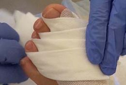 Verband nach Hallux valgus Operationen