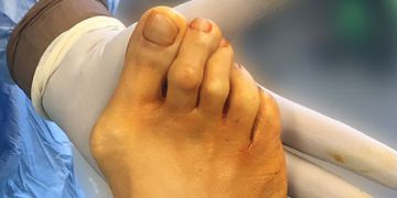 Lapidusarthrodese und lateralisierende distale minimalinvasive Metatarsaleosteotomie (DMMO) in der Behandlung eines Hallux valgus bei Pes adductus