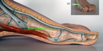 Abbildung 12: Als nächster Schritt erfolgt die dorsale Osteotomie.  Zu beachten ist, dass keine Hebelkräfte aufgewendet werden. Auch hier wird die Osteotomie mit dem Bildverstärker kontrolliert.