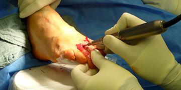 Distale minimalinvasive diaphysäre Osteotomie (DMDO)